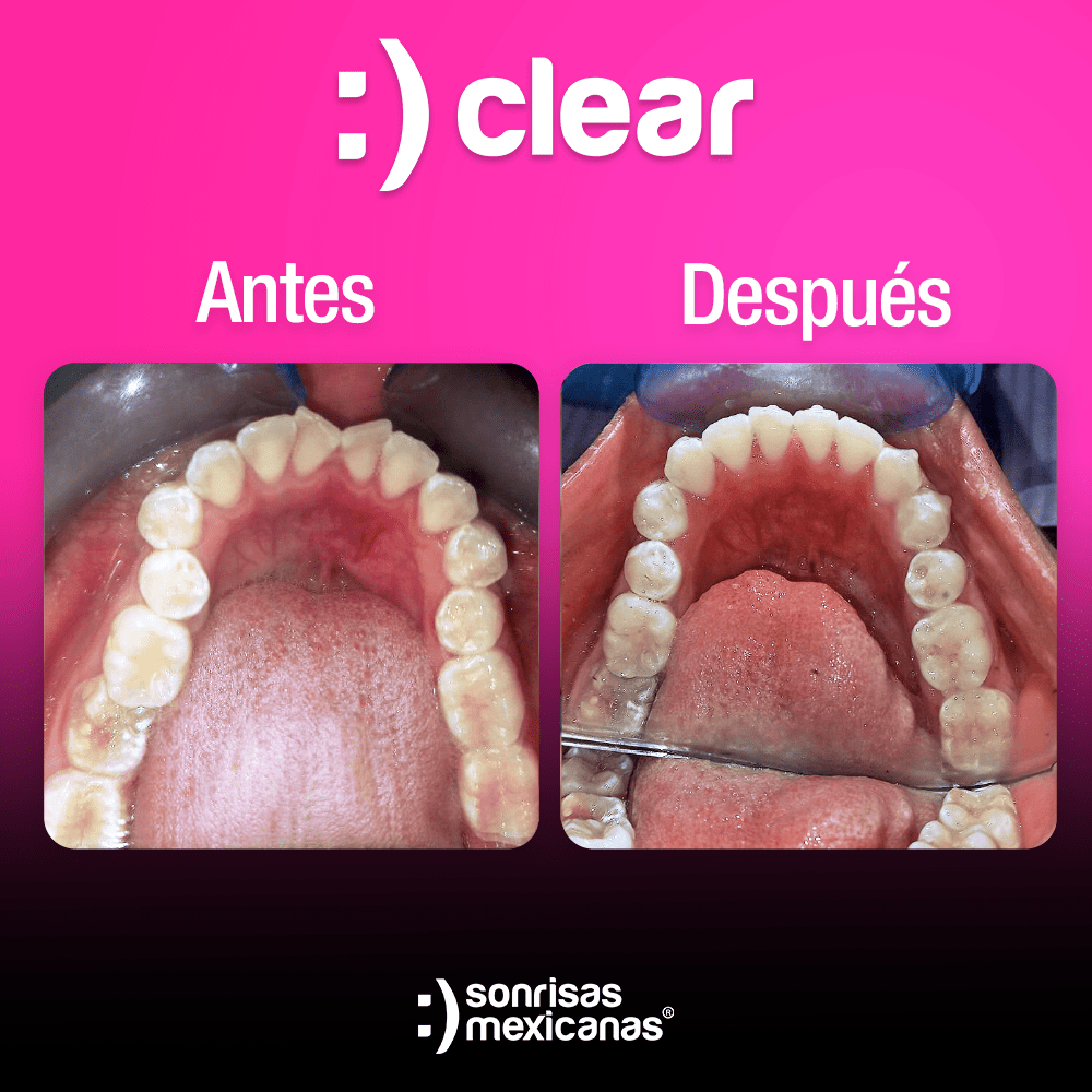 Antes y despues Alineadores invisibles