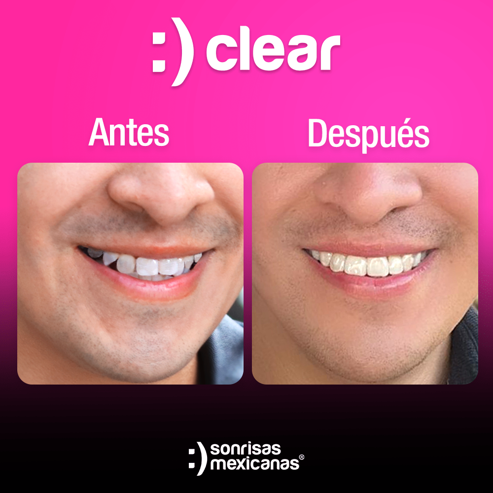 Antes y despues Alineadores invisibles