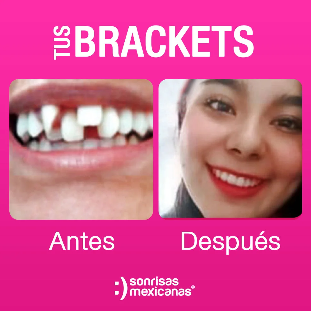 Brackets Sonrisas Mexicanas