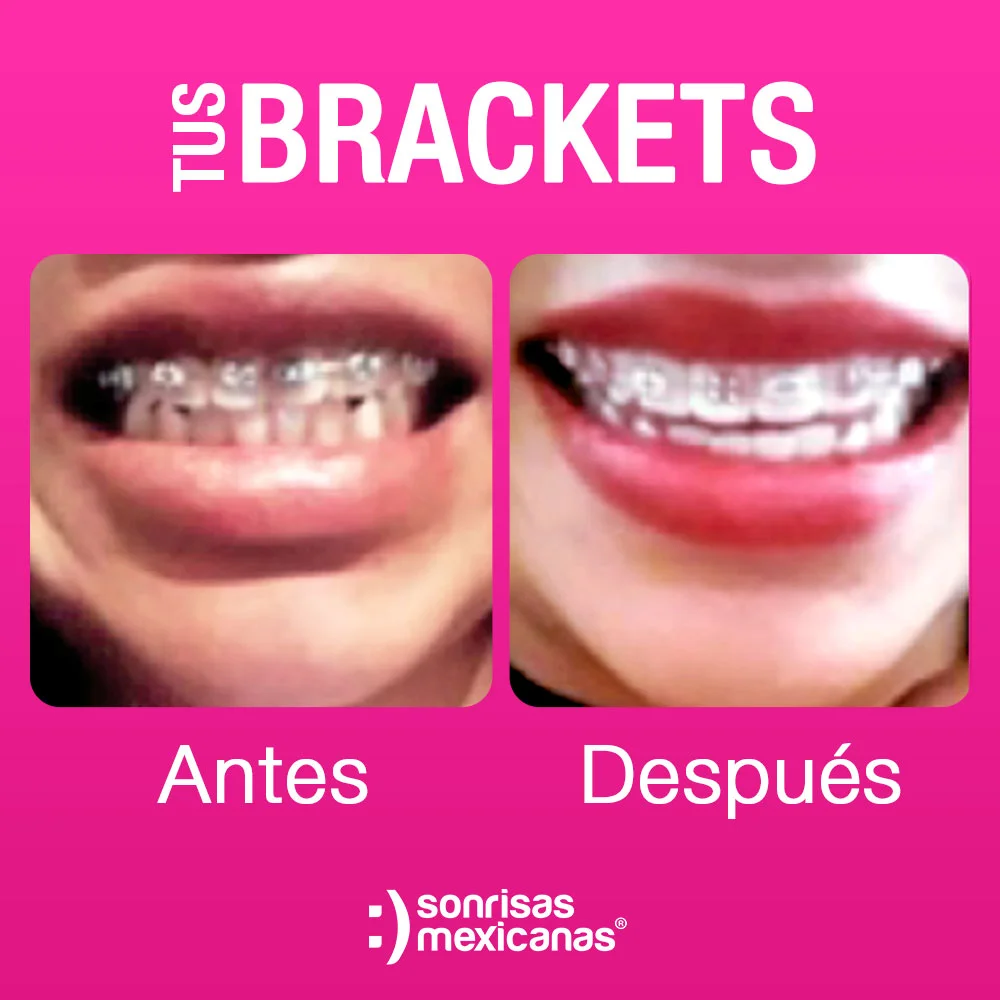 Brackets Sonrisas Mexicanas