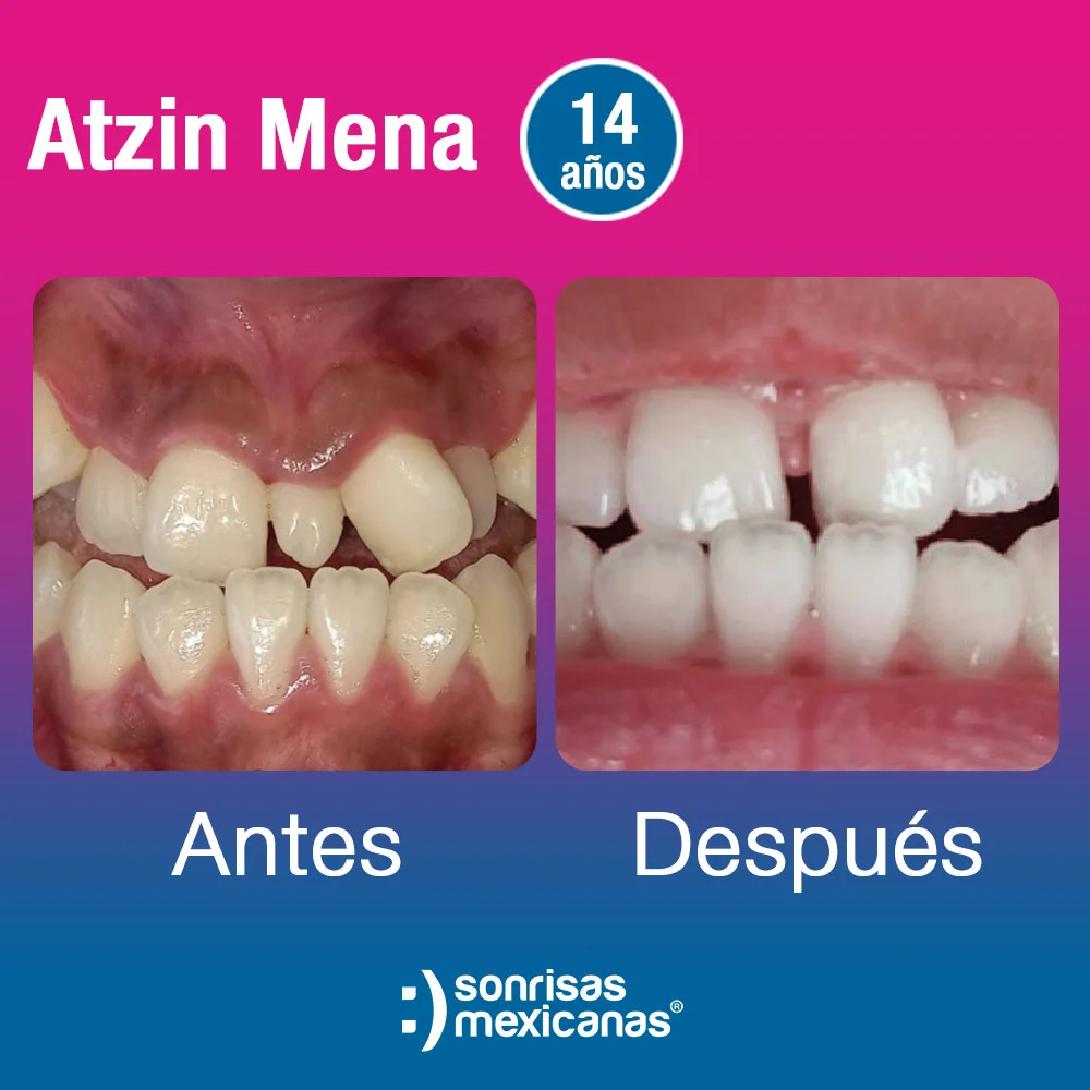 Tratamiento dental para niños