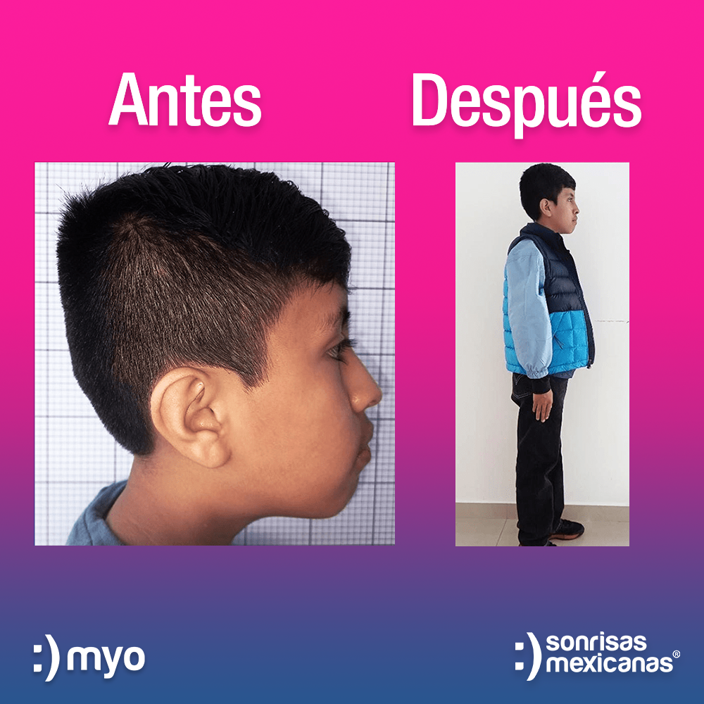 Alineación Dental para niños resultados