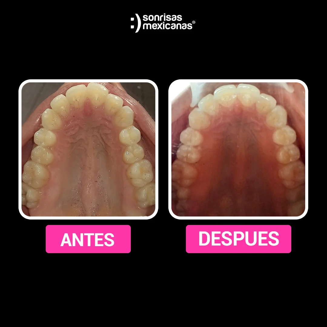 Antes y despues Ortodoncia