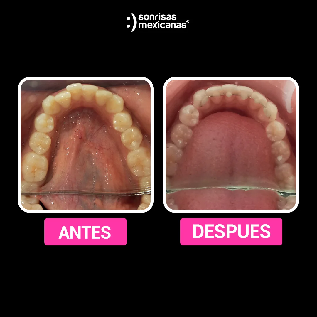 Antes y despues Alineadores invisibles