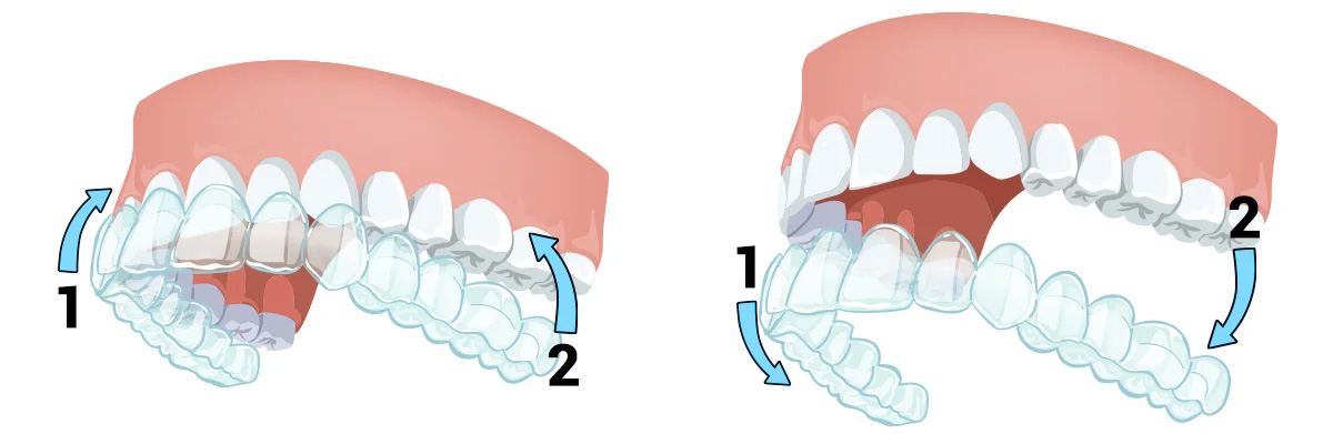 Como limpiar alineadores dentales en Sonrisas Mexicanas