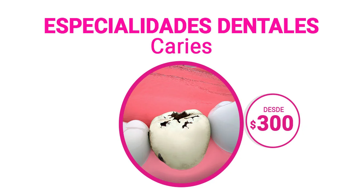 Tratamiento para Caries en Sonrisas Mexicanas