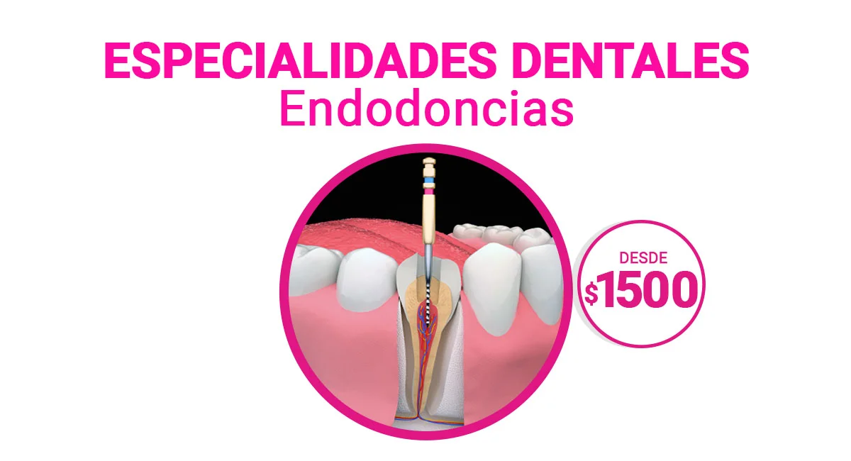 Endodoncias en Sonrisas Mexicanas