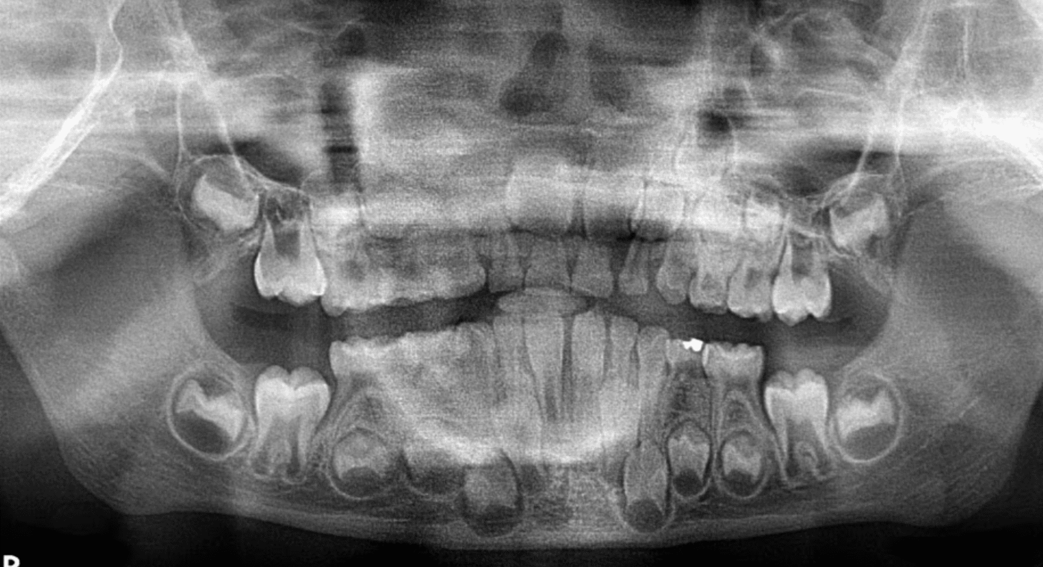 Radiografía Panorámica de paciente de 9 años