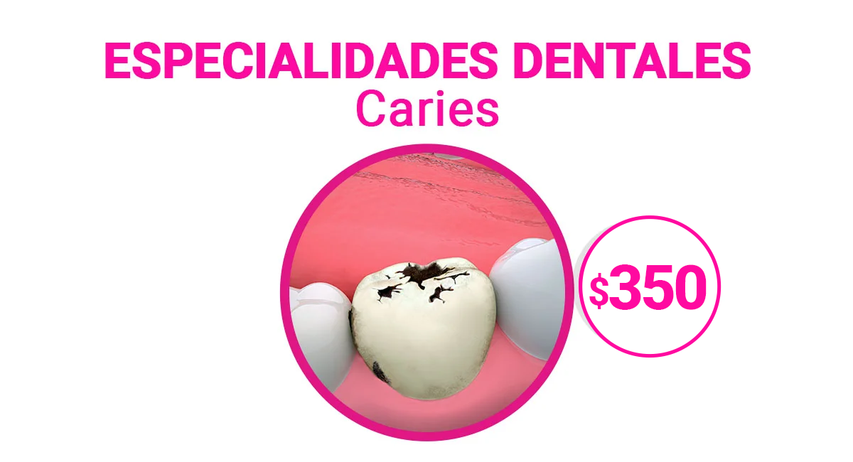 Tratamiento para Caries en Sonrisas Mexicanas