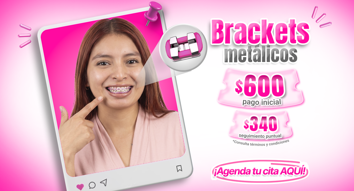 Brackets metálicos disponibles en Ciudad de México