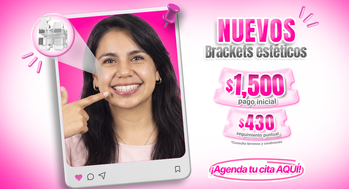Brackets estéticos disponibles en todo México